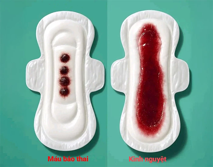 2. Xuất hiện máu báo thai (Implantation Bleeding)