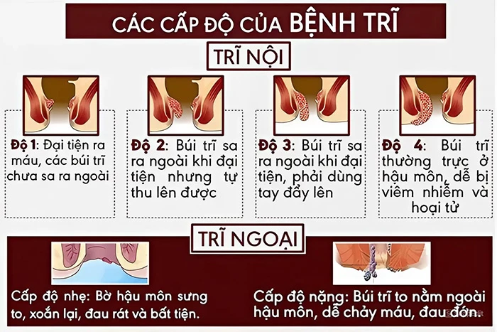 Dấu hiệu nhận biết và các cấp độ trĩ thai kỳ