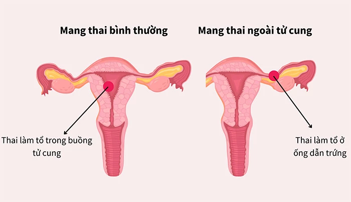 Thai ngoài tử cung là gì