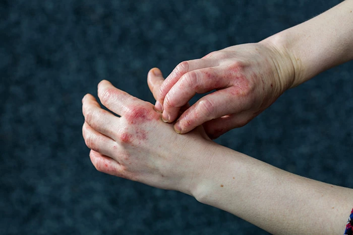 Cách nhận biết và xử lý viêm da tiếp xúc tránh để lại sẹo
