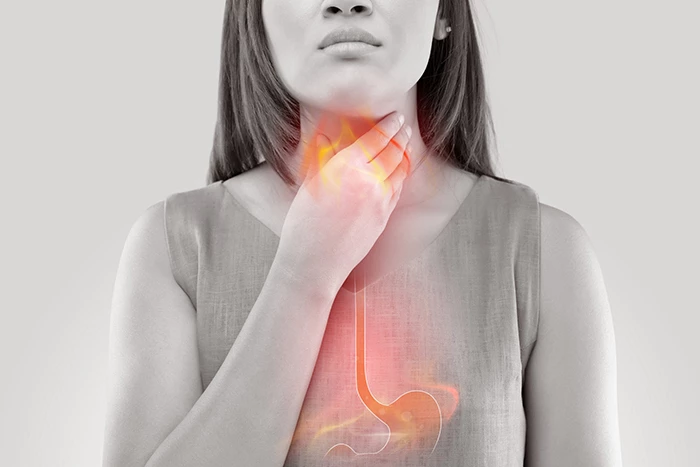 Đau họng triệu chứng trào ngược dạ dày thực quản.