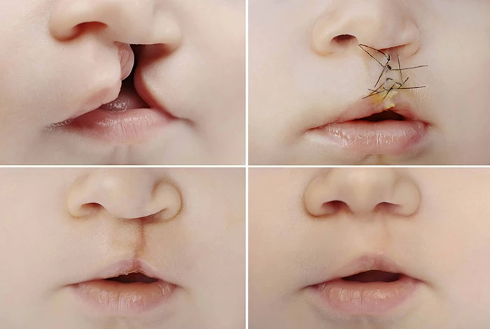 Sự thay đổi khuôn mặt một cách kỳ diệu sau phẫu thuật sứt môi hở hàm ếch