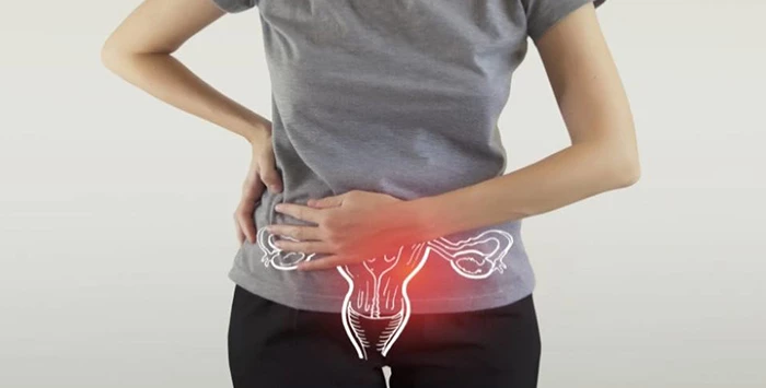 Lạc nội mạc tử cung là một trong những nguyên nhân gây đau bụng kinh thứ phát ở nữ giới.