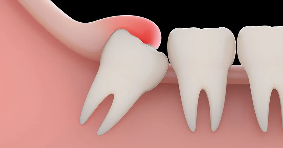 Răng khôn là răng nào, nhổ răng khôn có nguy hiểm không?