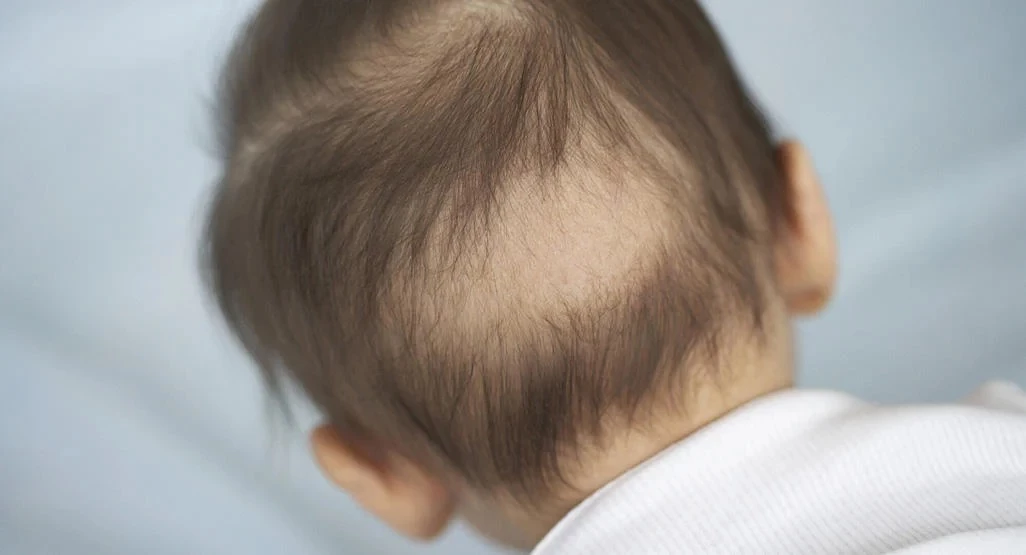 Trẻ bị rụng tóc hình vành khăn là một trong những dấu hiệu trẻ có thể bị thiếu vitamin D