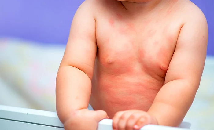 Phát ban - Một triệu chứng khi trẻ bị dị ứng sữa.