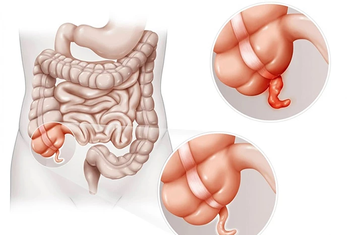 Viêm ruột thừa thường bắt đầu bằng một cơn đau ở giữa bụng sau đó lan xuống phía dưới bên phải.